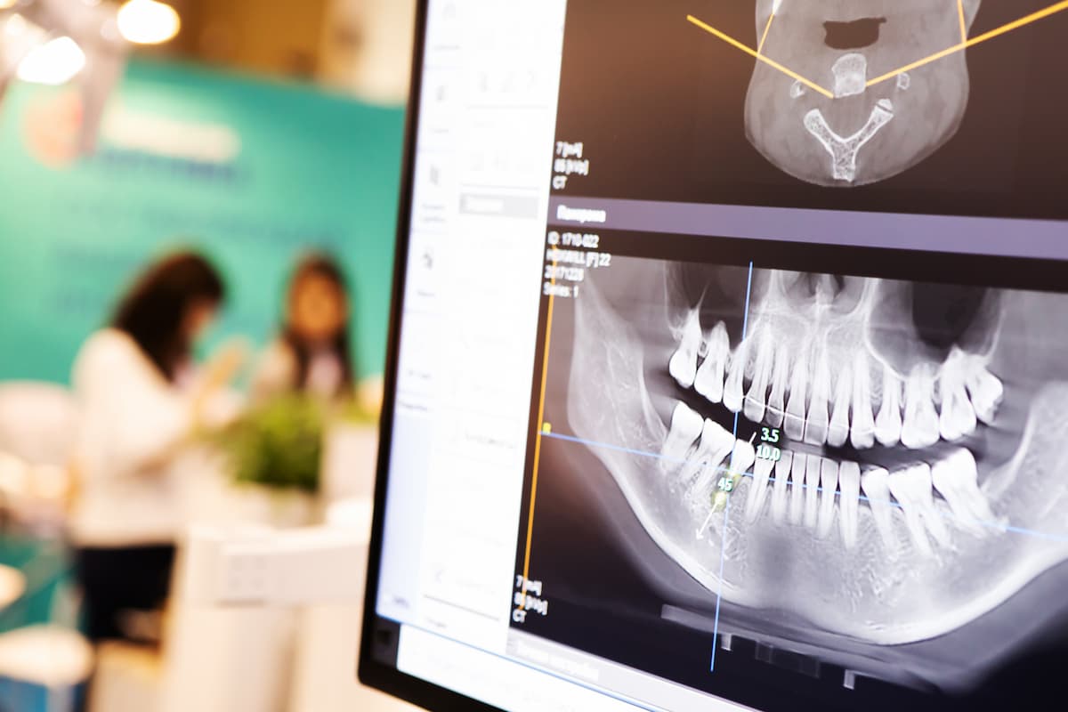 Why Does Bone Health Matter for Dental Implants?